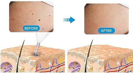 5-in-1 Plasma Jet Pen - Tattoo, Wart & Skin Lesion Removal1 - Image 11