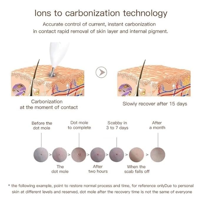 5-in-1 Plasma Jet Pen - Tattoo, Wart & Skin Lesion Removal1 - Image 3